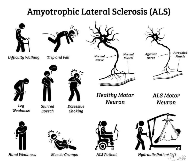 is-this-split-hand-syndrome-als-support-community